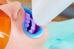 Prosedur Bleaching Sinar UV